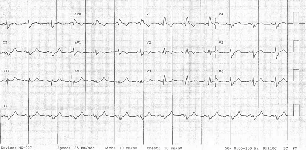 OMI ECG Proximal LAD RBBB