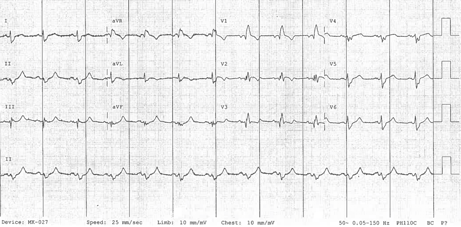 Right Bundle Branch Block RBBB LITFL ECG Library Diagnosis