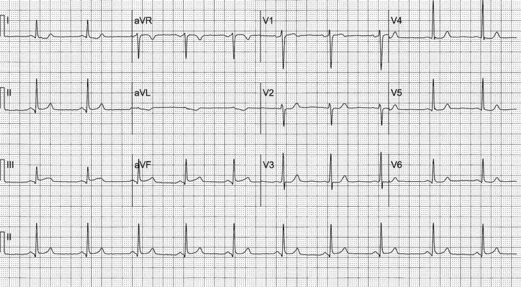 OMI ECG ST-segment changes. some subtle, some obvious