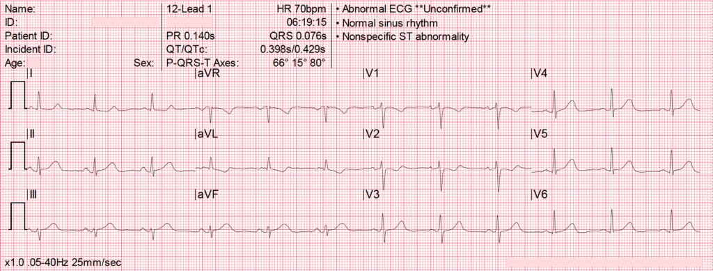 OMI ECG early inferior OMI