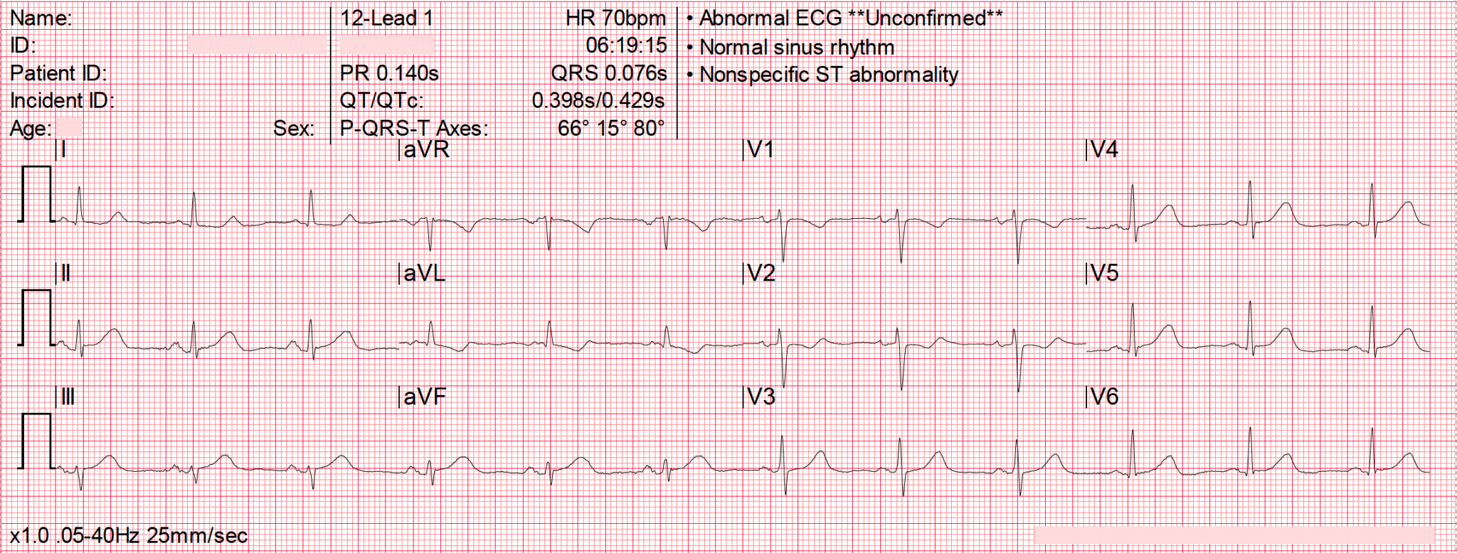 OMI: Replacing the STEMI misnomer • LITFL • ECG Library