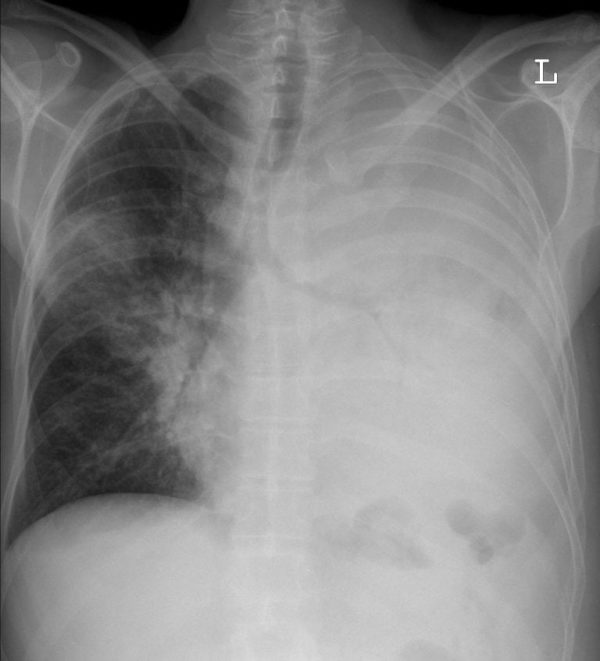 CXR Case 007 • LITFL • Chest X-ray Self-Assessment Quiz