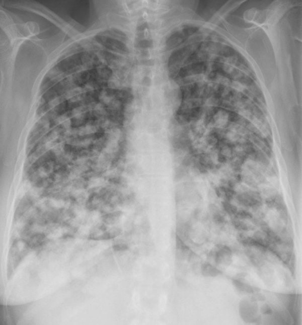 CXR CASE 021 LITFL