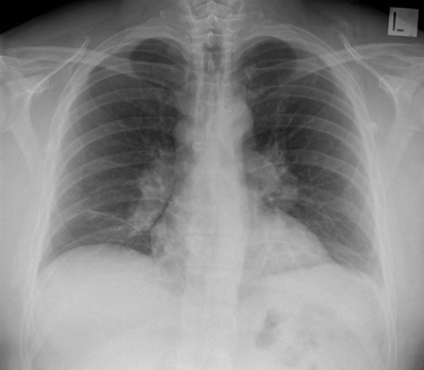 CXR CASE 029 CXR LITFL