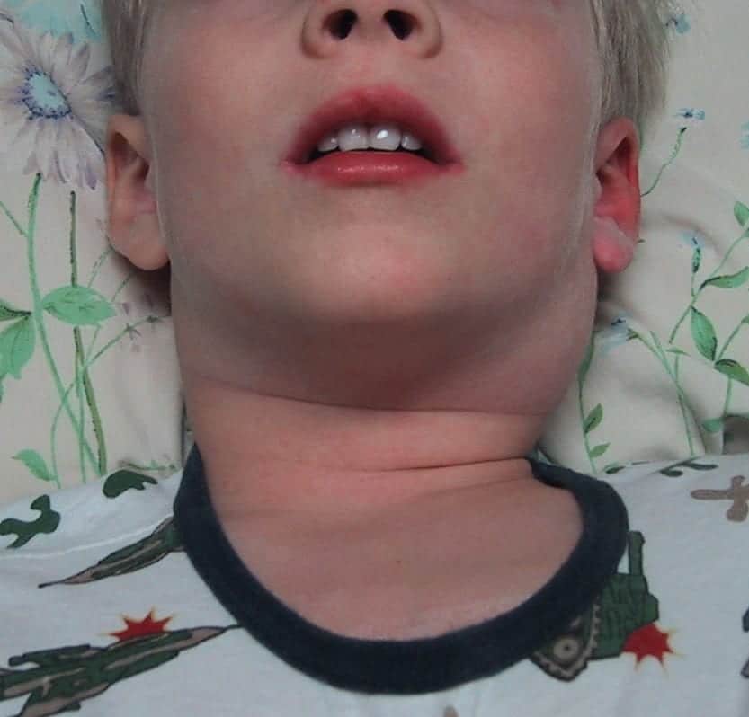 Cervical Lymphadenopathy Kawasaki Disease