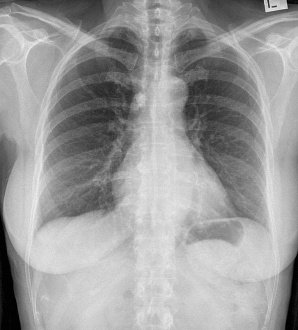 CXR CASE 044 CXR LITFL