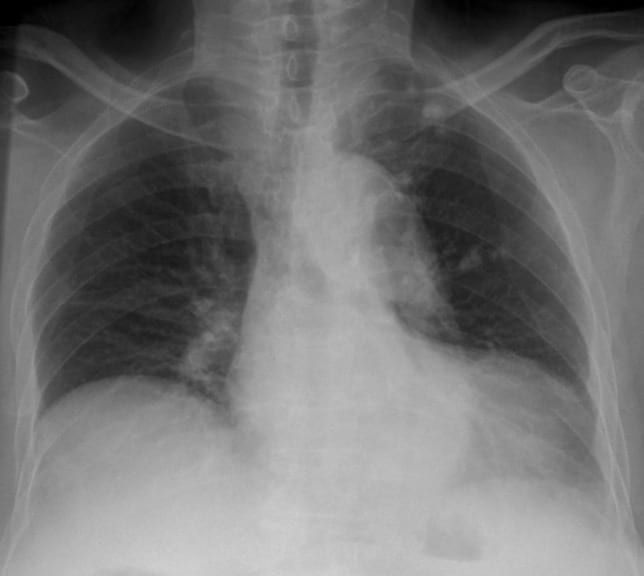 CXR CASE 047 CXR LITFL