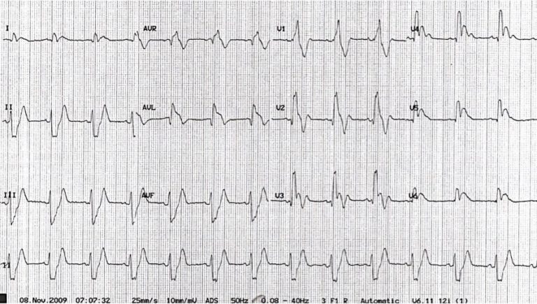 Electrocardiographic Exigency • LITFL • Clinical Cases ECG Exigency
