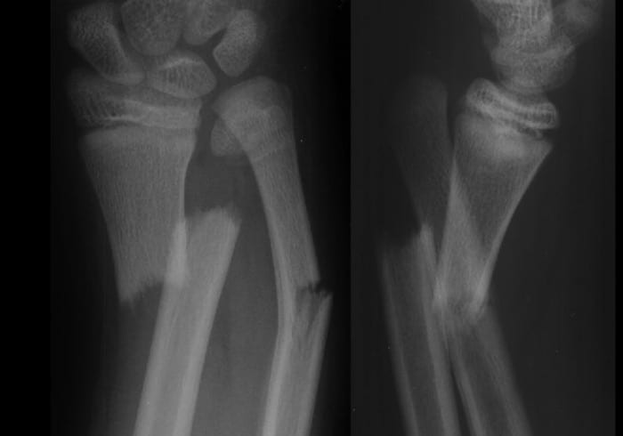 open fracture x ray