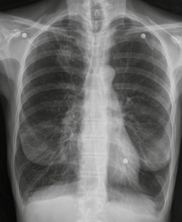 CXR Case 062 • LITFL • Chest Xray SelfAssessment Quiz