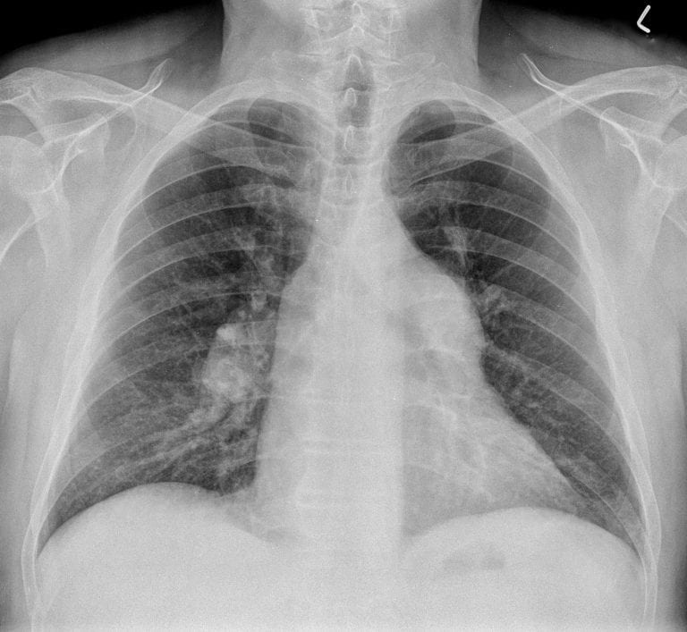 CXR Case 063 • LITFL • Chest X-ray Self-Assessment Quiz