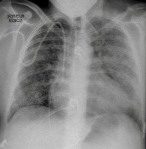 CXR CASE 081 CXR LITFL