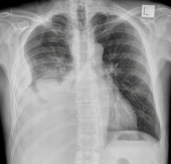 CXR Case 085 • LITFL • Chest X-ray Self-Assessment Quiz