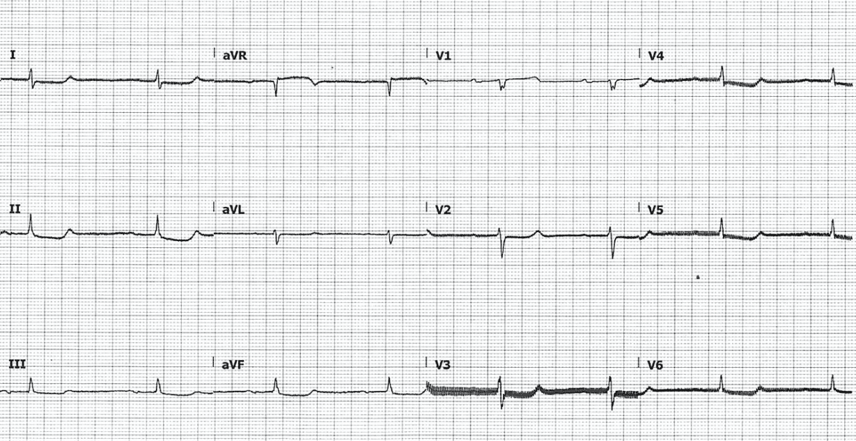 life in the fast lane ekg practice