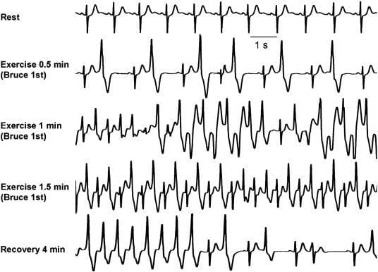 polymorphic ventricular tachycardia