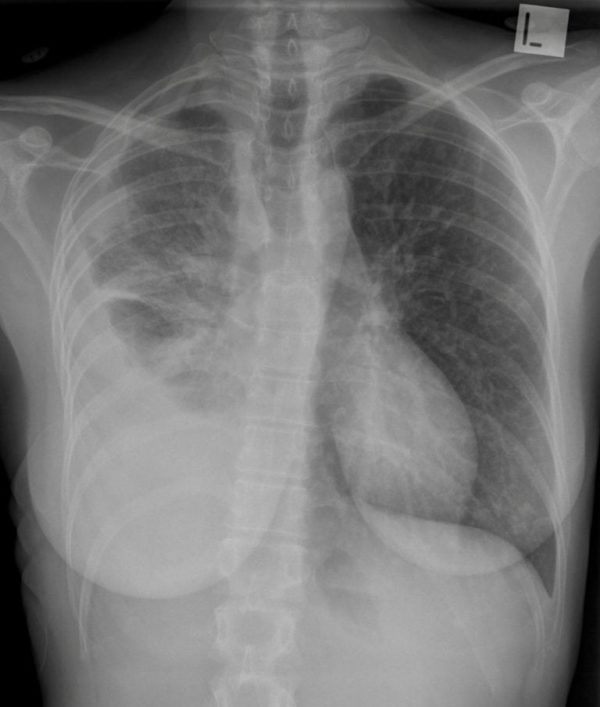 CXR Case 094 • LITFL • Chest X-ray Self-Assessment Quiz