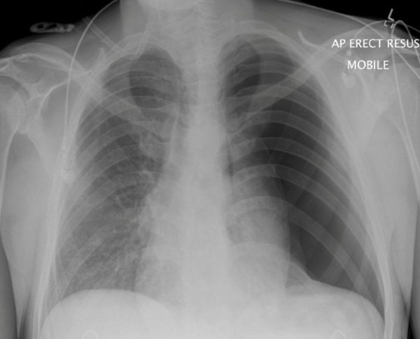 CXR CASE 099 CXR LITFL