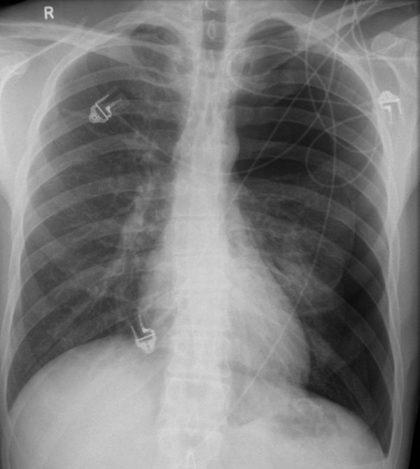 CXR CASE 101 CXR LITFL