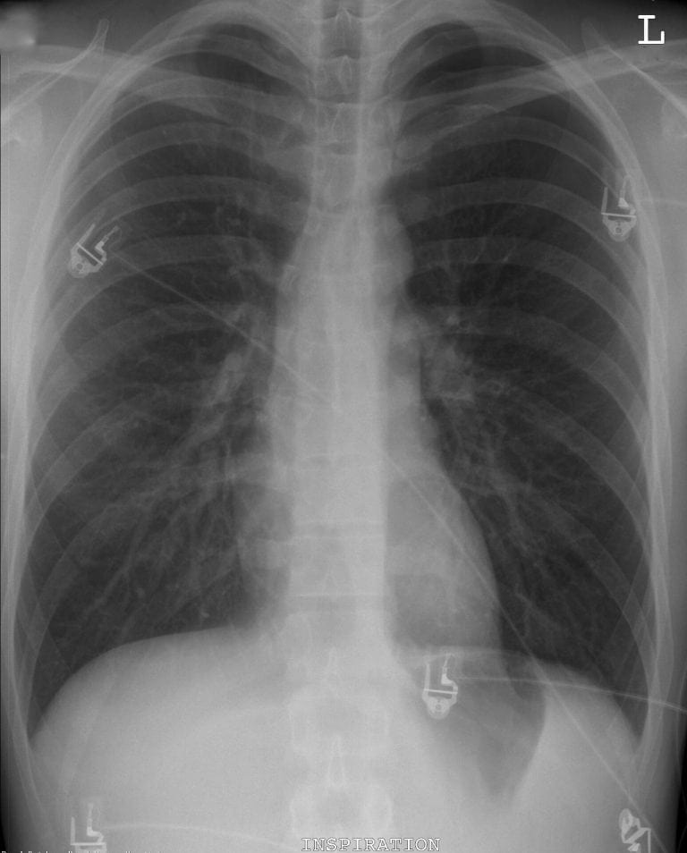 CXR Case 102 • LITFL • Chest X-ray Self-Assessment Quiz