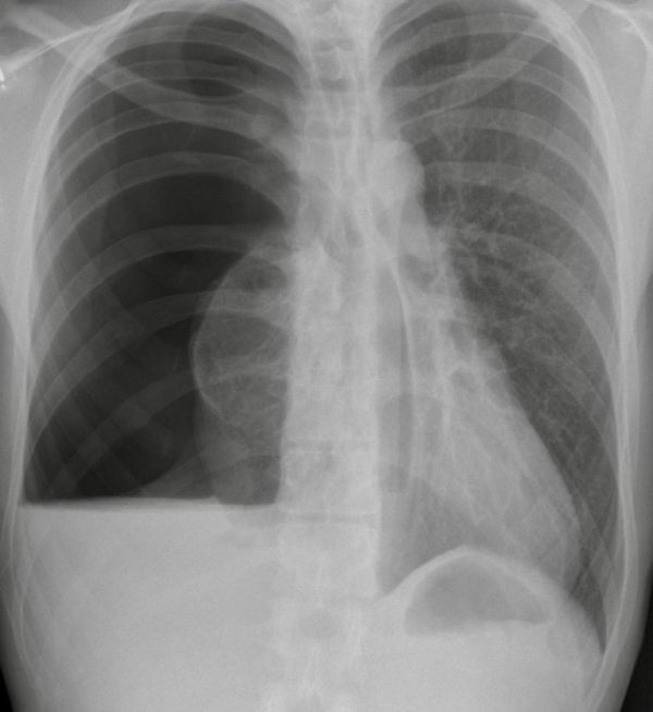 CXR CASE 103 CXR LITFL