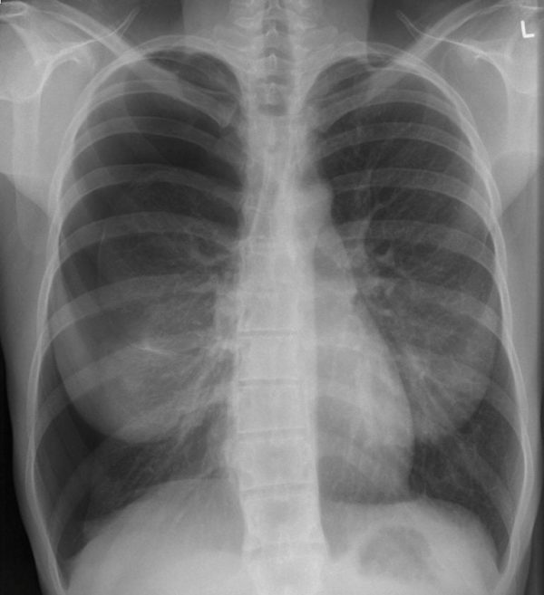 CXR CASE 104 CXR LITFL