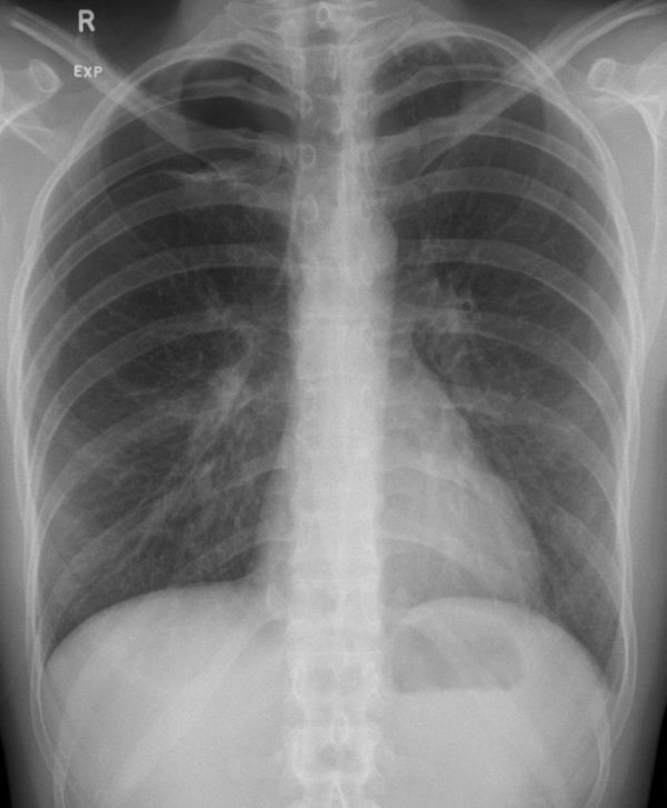 CXR CASE 106 CXR LITFL