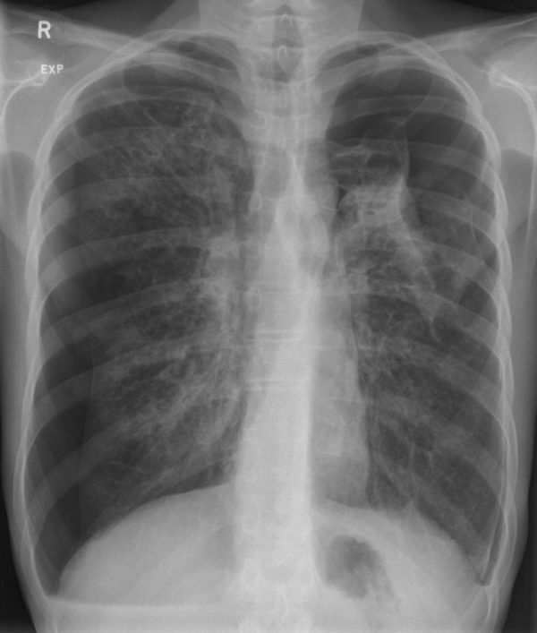 CXR CASE 107 CXR LITFL