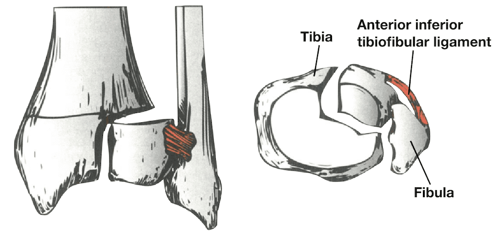 Tillaux Fractures orthobullets