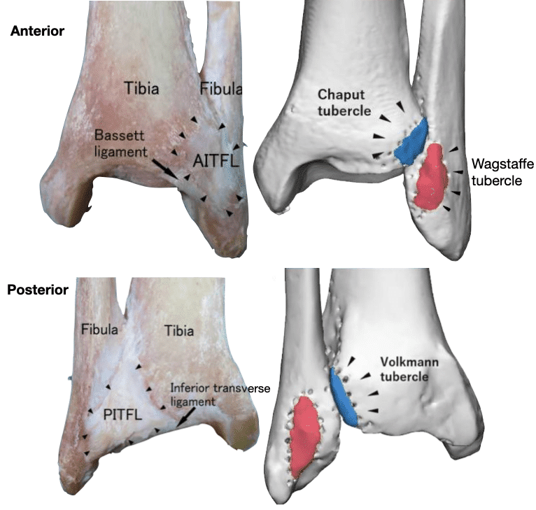 AITFL PITFL anatomical tubercles 2020 3D CT