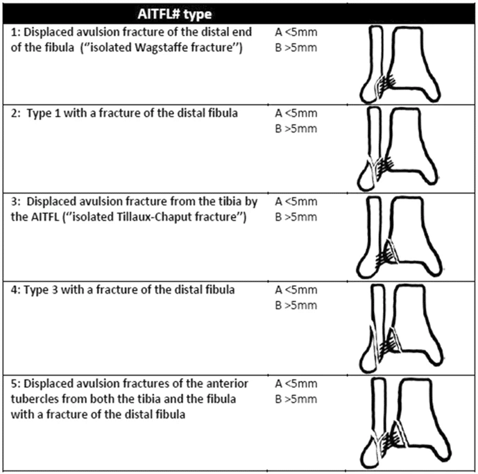 types of fibular fractures