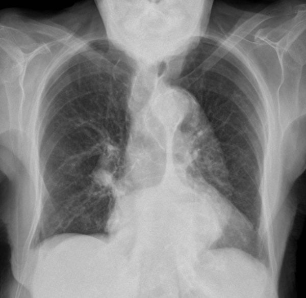 CXR CASE 125 CXR LITFL