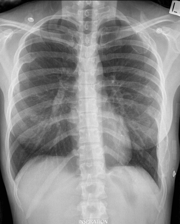 CXR CASE 127 CXR LITFL