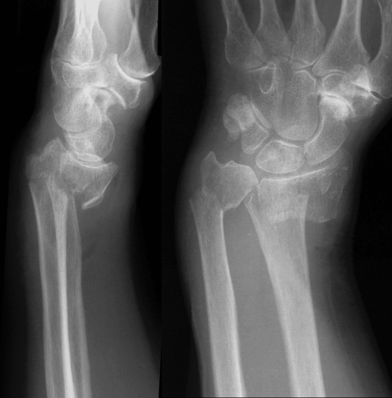 colles fracture vs smith fracture x ray