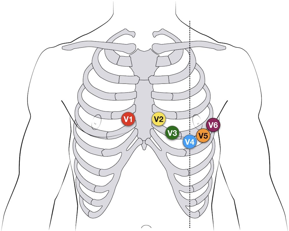 Ecg Electrode Placement Chart