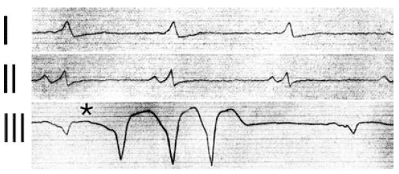 Wolff–Parkinson–White syndrome • LITFL • Medical Eponym Library