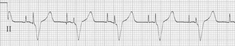 Pacemaker Rhythms – Normal Patterns • LITFL • ECG Library Diagnosis