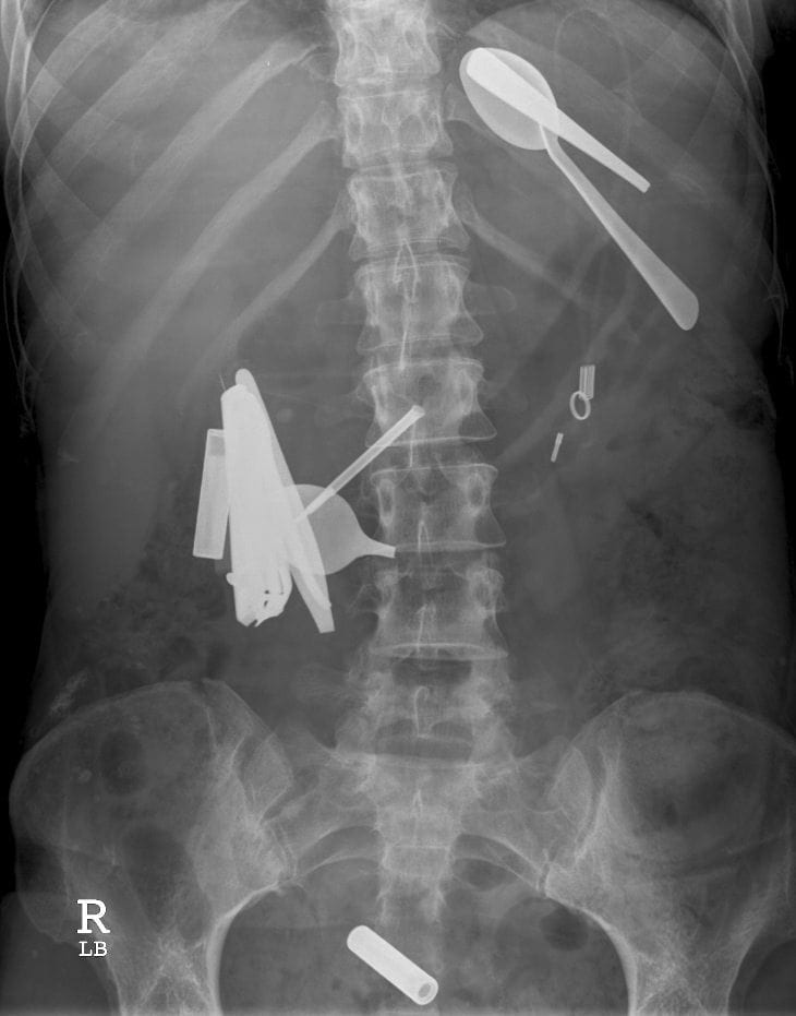 Foreign objects in chest X-rays