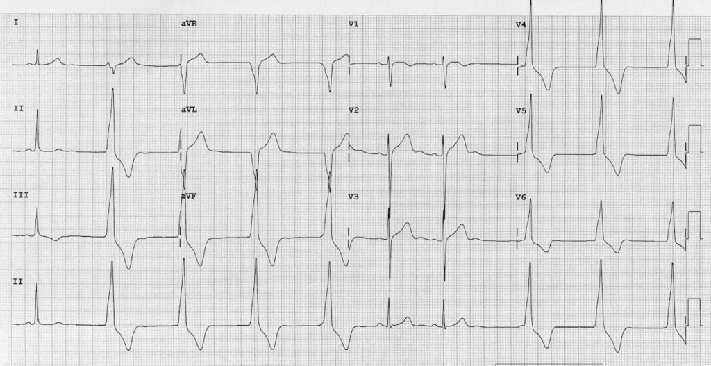 Accelerated Idioventricular Rhythm (AIVR) ECG 1