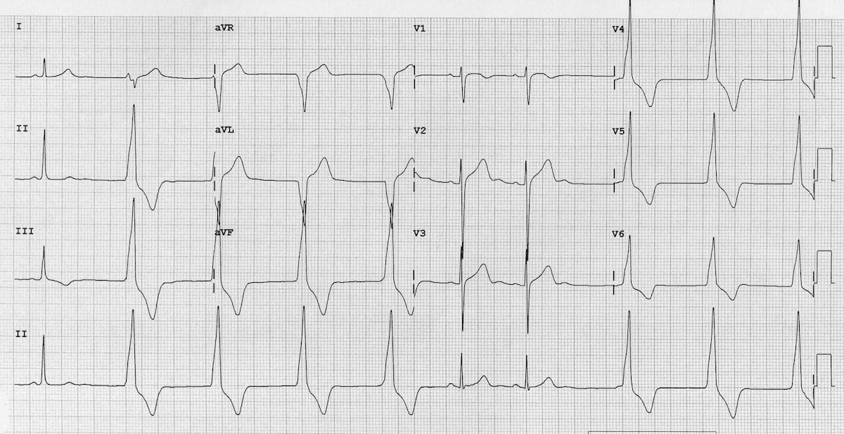 Electrocardiogram (ECG) Importance, ECG Test Results,, 46% OFF