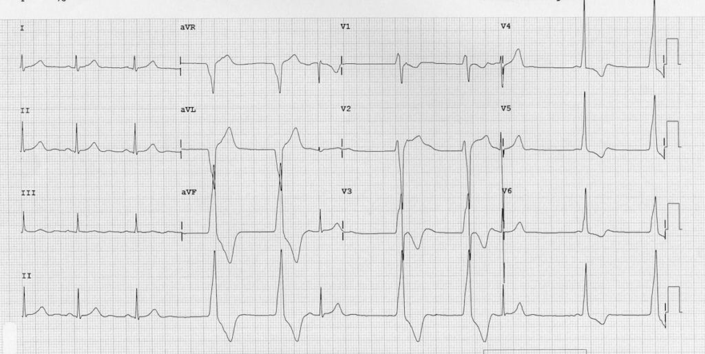 Accelerated Idioventricular Rhythm (AIVR) ECG 2