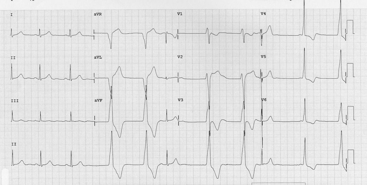 ECG strip showing an accelerated idioventricular rhythm