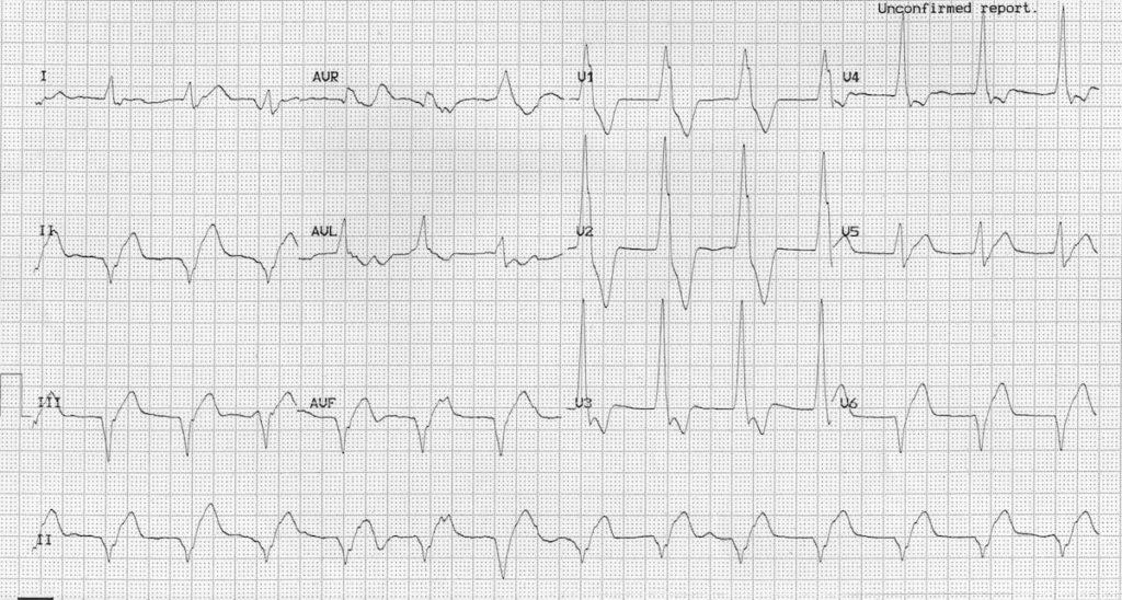 Accelerated Idioventricular Rhythm (AIVR) ECG 3