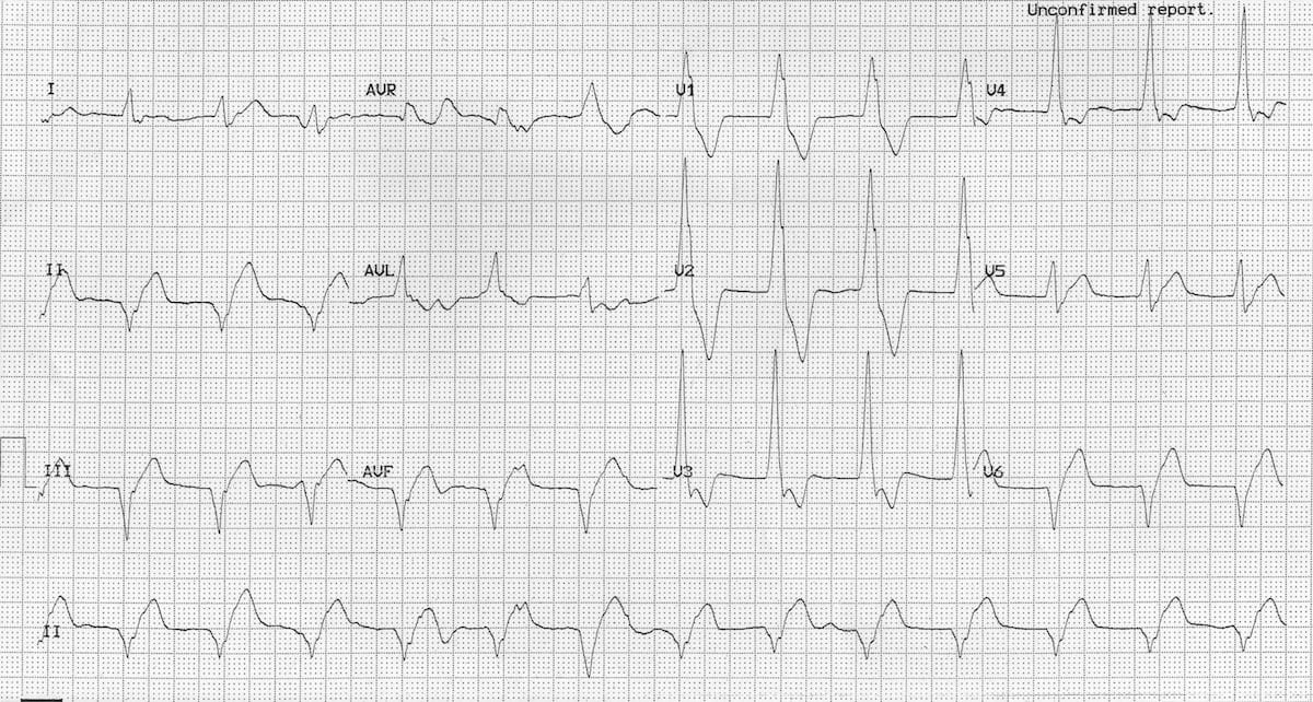 Accelerated Idioventricular Rhythm AIVR LITFL ECG Library