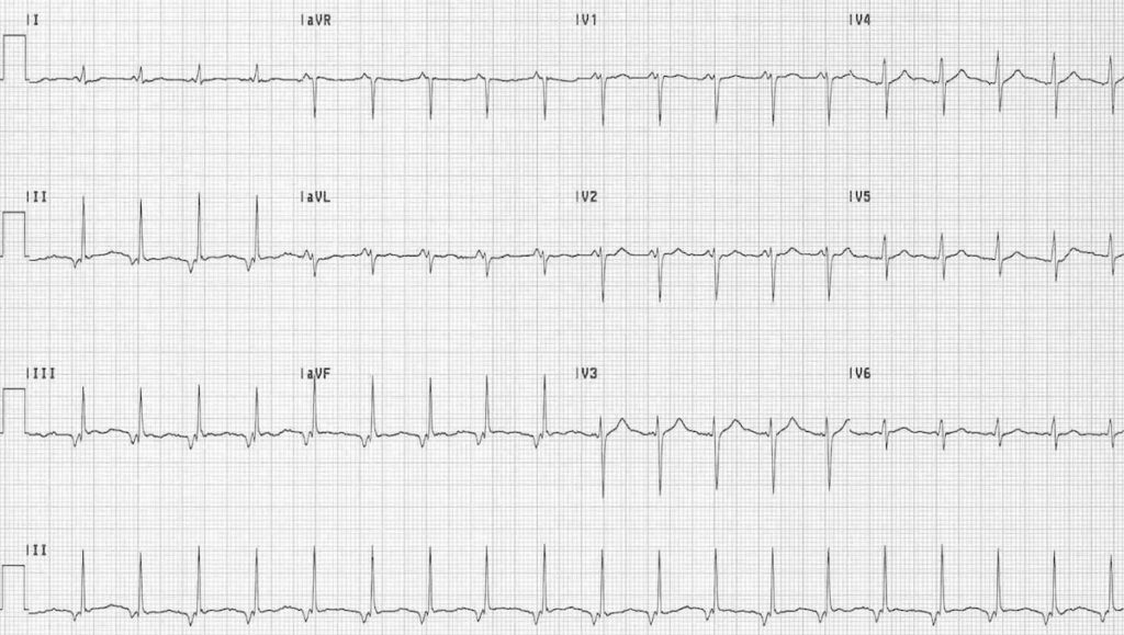 Accelerated Junctional Rhythm (AJR) ECG 3