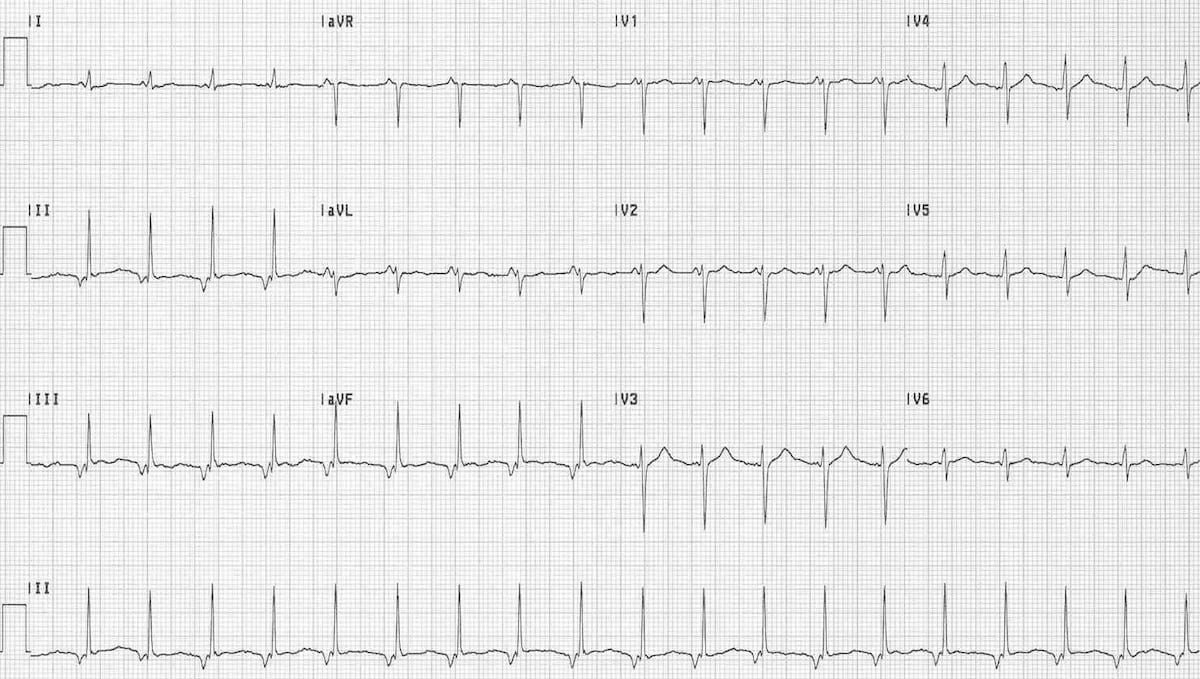 Junctional Tachycardia