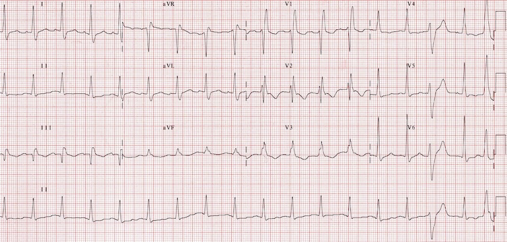 T Wave Litfl Ecg Library Basics