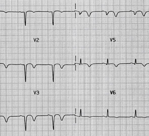 t-wave-litfl-ecg-library-basics