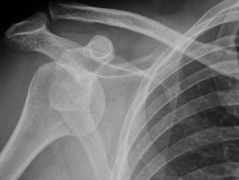 Anterior shoulder dislocation FARES