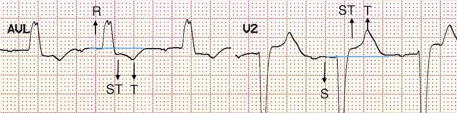 premature ventricular contraction ecg