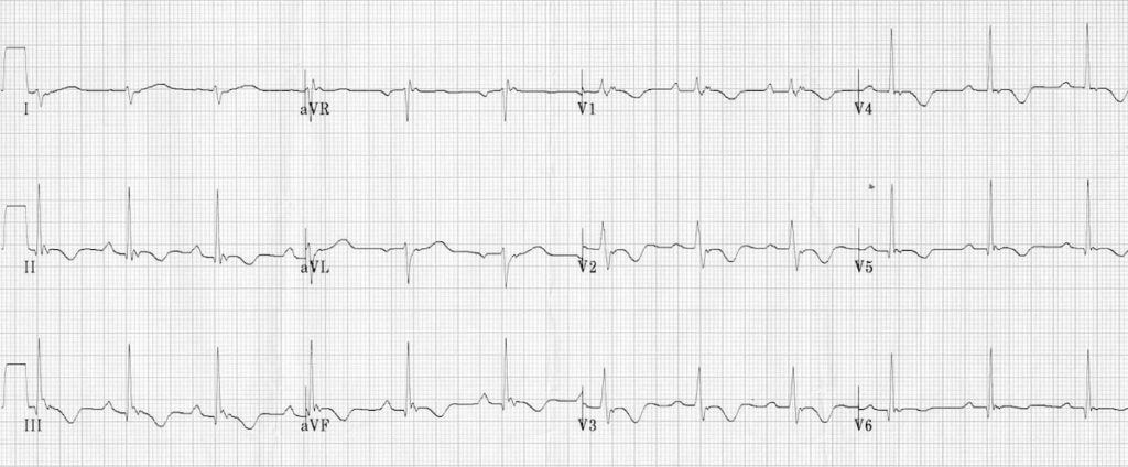 Arrhythmogenic Right Ventricular Cardiomyopathy (ARVC) ECG ARVD